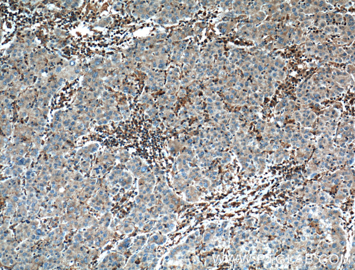 Immunohistochemistry (IHC) staining of human liver cancer tissue using EPHA1-specific Monoclonal antibody (60155-2-Ig)