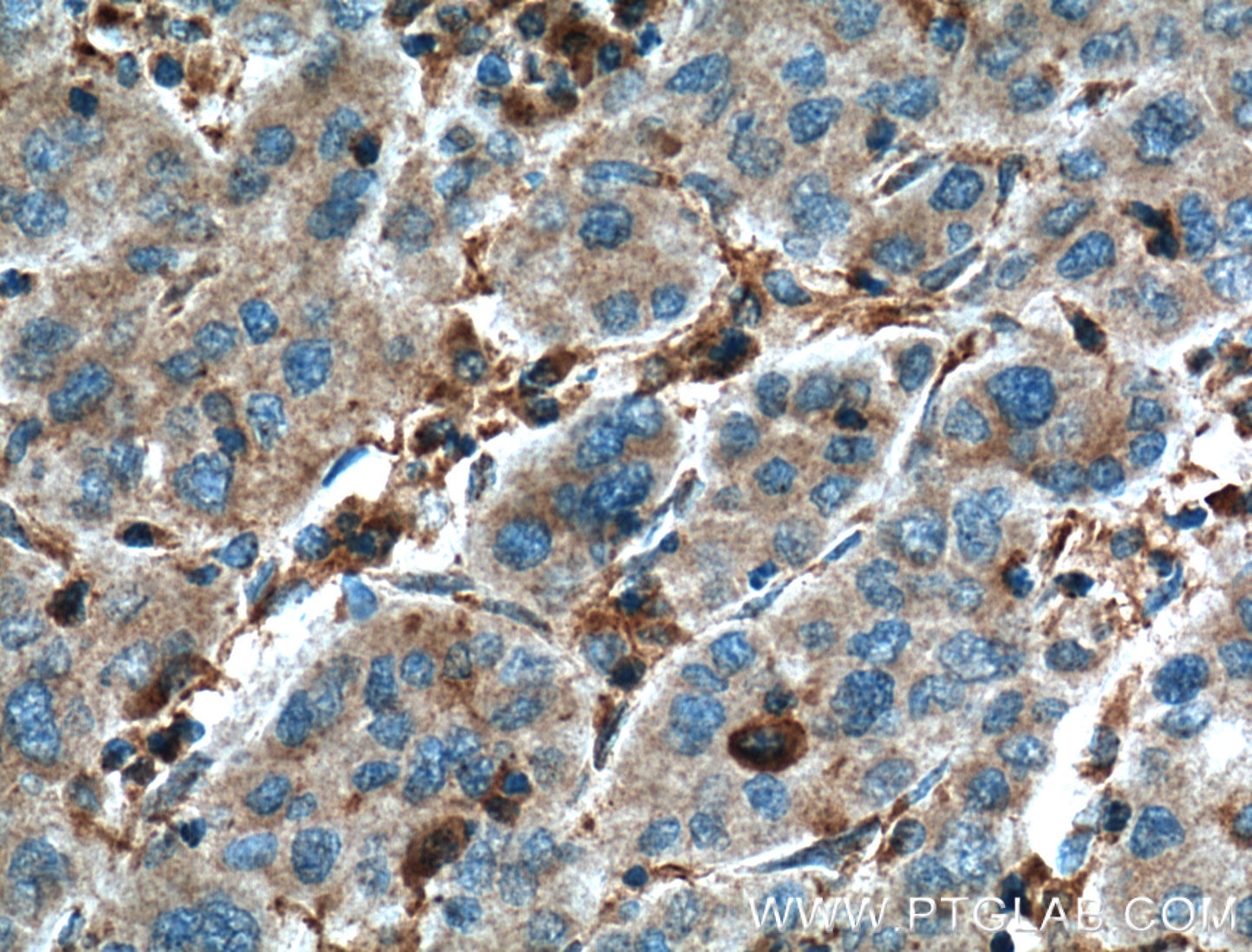 Immunohistochemistry (IHC) staining of human liver cancer tissue using EPHA1-specific Monoclonal antibody (60155-2-Ig)