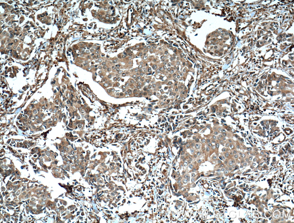 IHC staining of human breast cancer using 60155-2-Ig