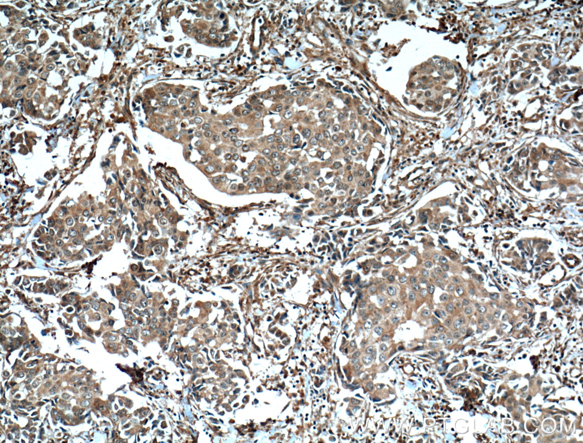 Immunohistochemistry (IHC) staining of human breast cancer tissue using EPHA1-specific Monoclonal antibody (60155-2-Ig)