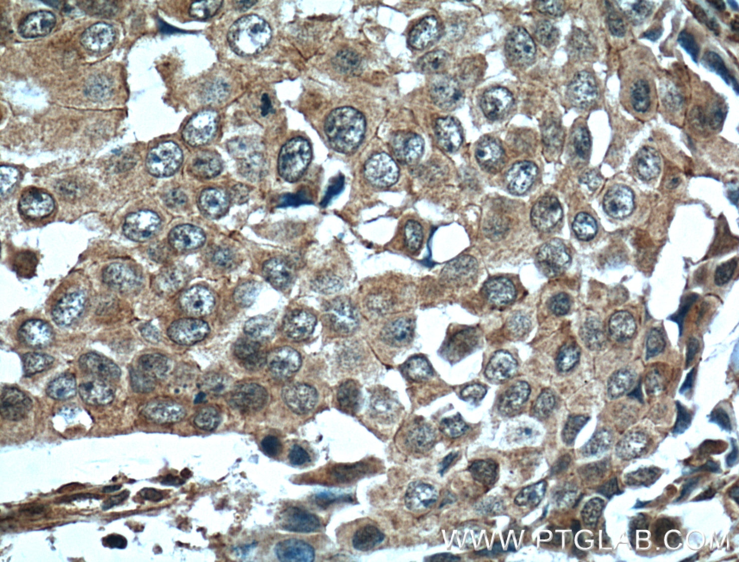 Immunohistochemistry (IHC) staining of human breast cancer tissue using EPHA1-specific Monoclonal antibody (60155-2-Ig)