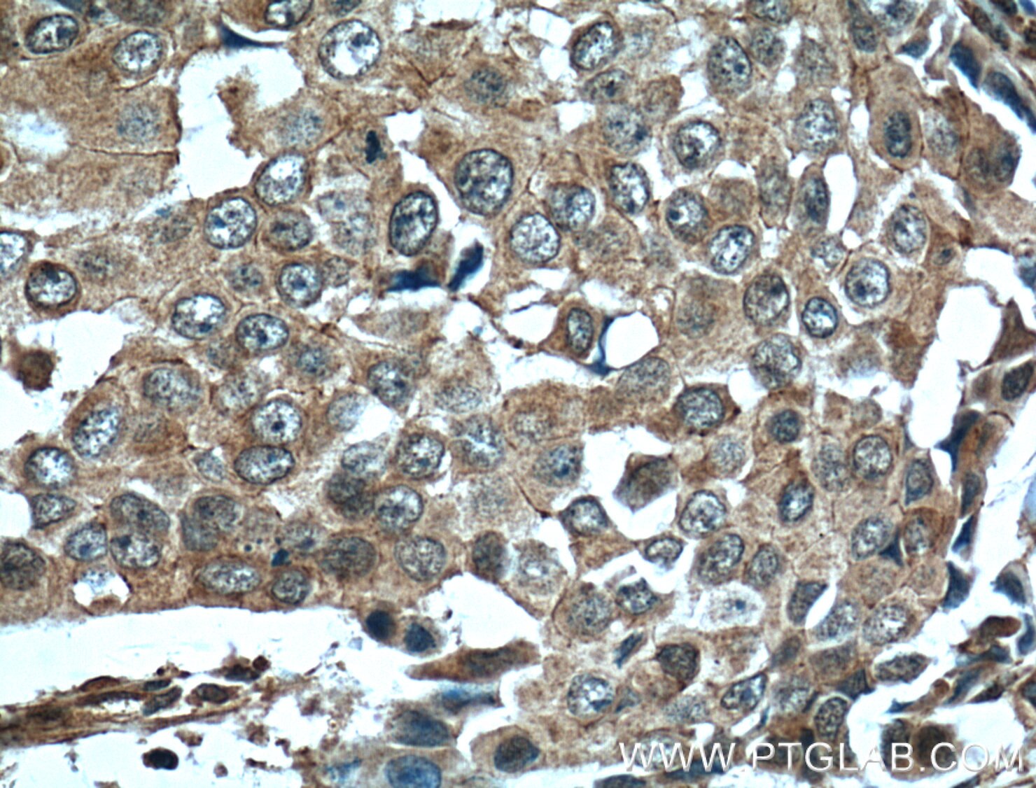 IHC staining of human breast cancer using 60155-2-Ig