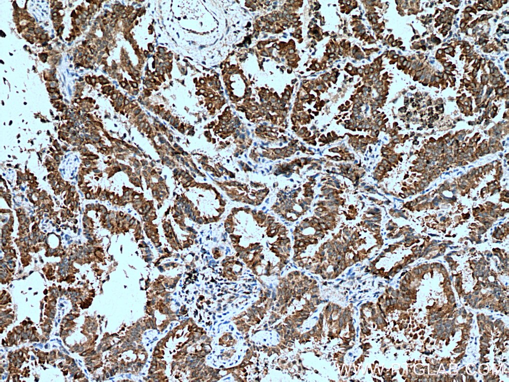 Immunohistochemistry (IHC) staining of human lung cancer tissue using EPHB4 Polyclonal antibody (20883-1-AP)