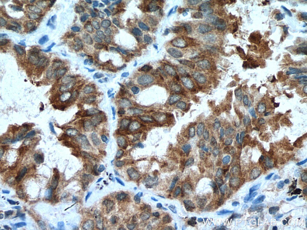 Immunohistochemistry (IHC) staining of human lung cancer tissue using EPHB4 Polyclonal antibody (20883-1-AP)