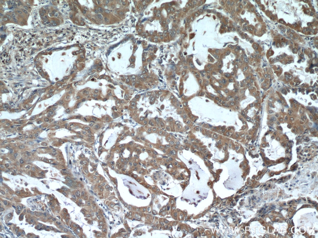 Immunohistochemistry (IHC) staining of human lung cancer tissue using EPHB4 Polyclonal antibody (20883-1-AP)