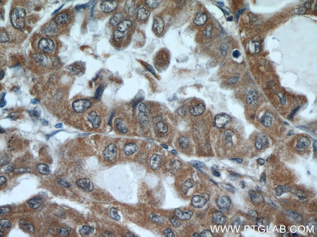 Immunohistochemistry (IHC) staining of human lung cancer tissue using EPHB4 Polyclonal antibody (20883-1-AP)