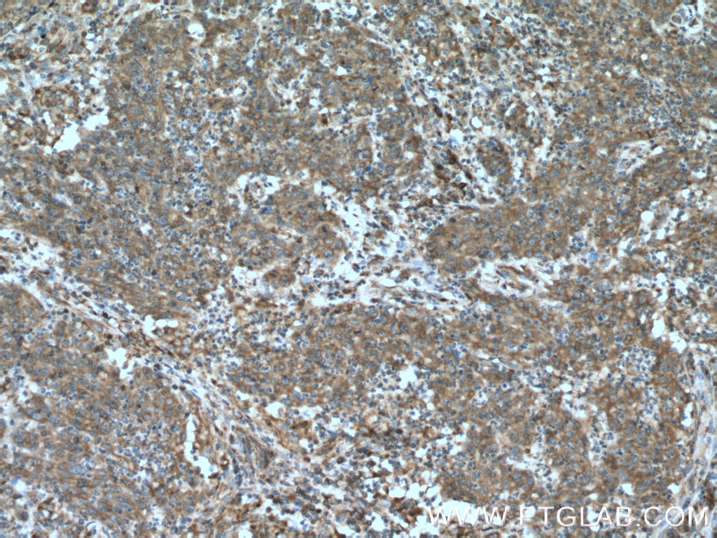 Immunohistochemistry (IHC) staining of human colon cancer tissue using EPHX2 Polyclonal antibody (10833-1-AP)