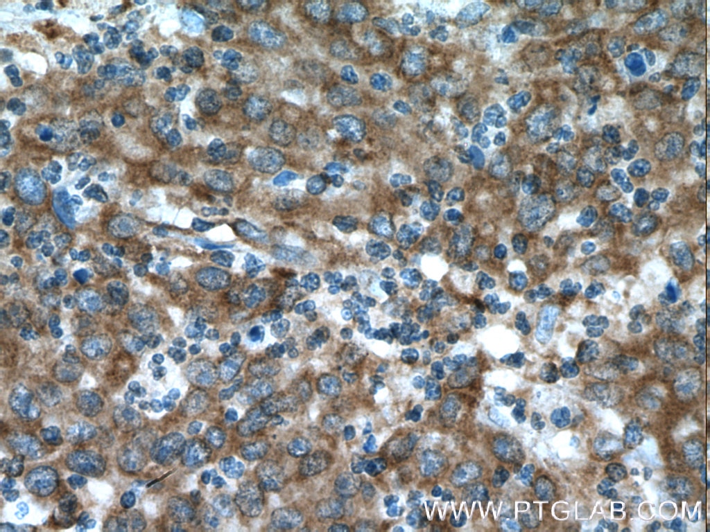 Immunohistochemistry (IHC) staining of human colon cancer tissue using EPHX2 Polyclonal antibody (10833-1-AP)