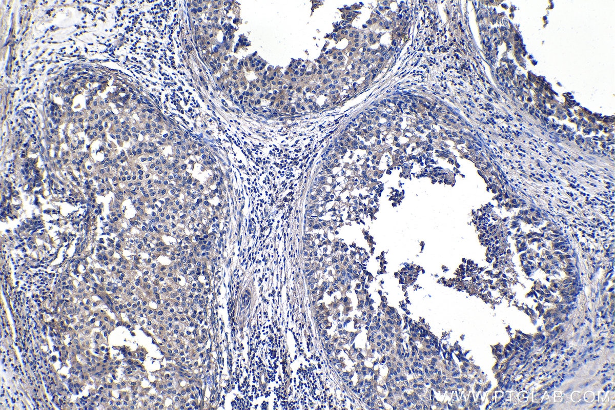 Immunohistochemistry (IHC) staining of human breast cancer tissue using EPHX2 Monoclonal antibody (67322-1-Ig)