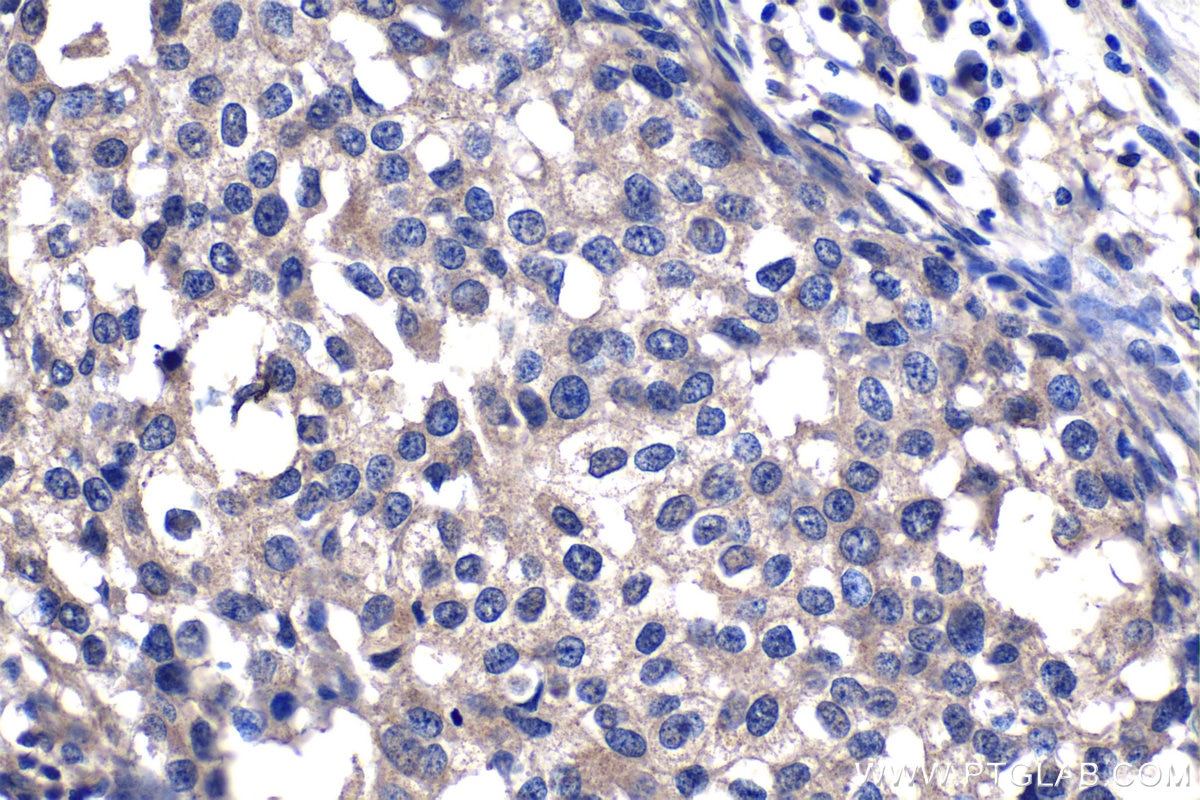 IHC staining of human breast cancer using 67322-1-Ig