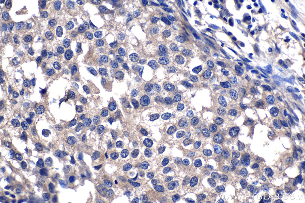 Immunohistochemistry (IHC) staining of human breast cancer tissue using EPHX2 Monoclonal antibody (67322-1-Ig)