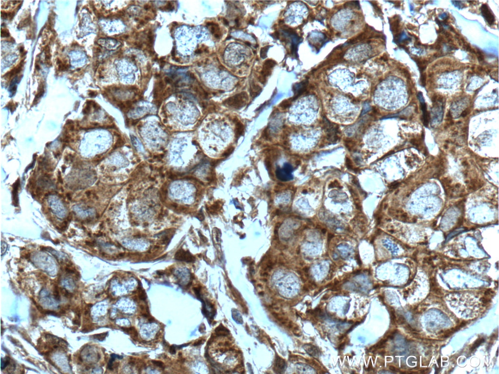 Immunohistochemistry (IHC) staining of human breast cancer tissue using EPHX3 Polyclonal antibody (25608-1-AP)
