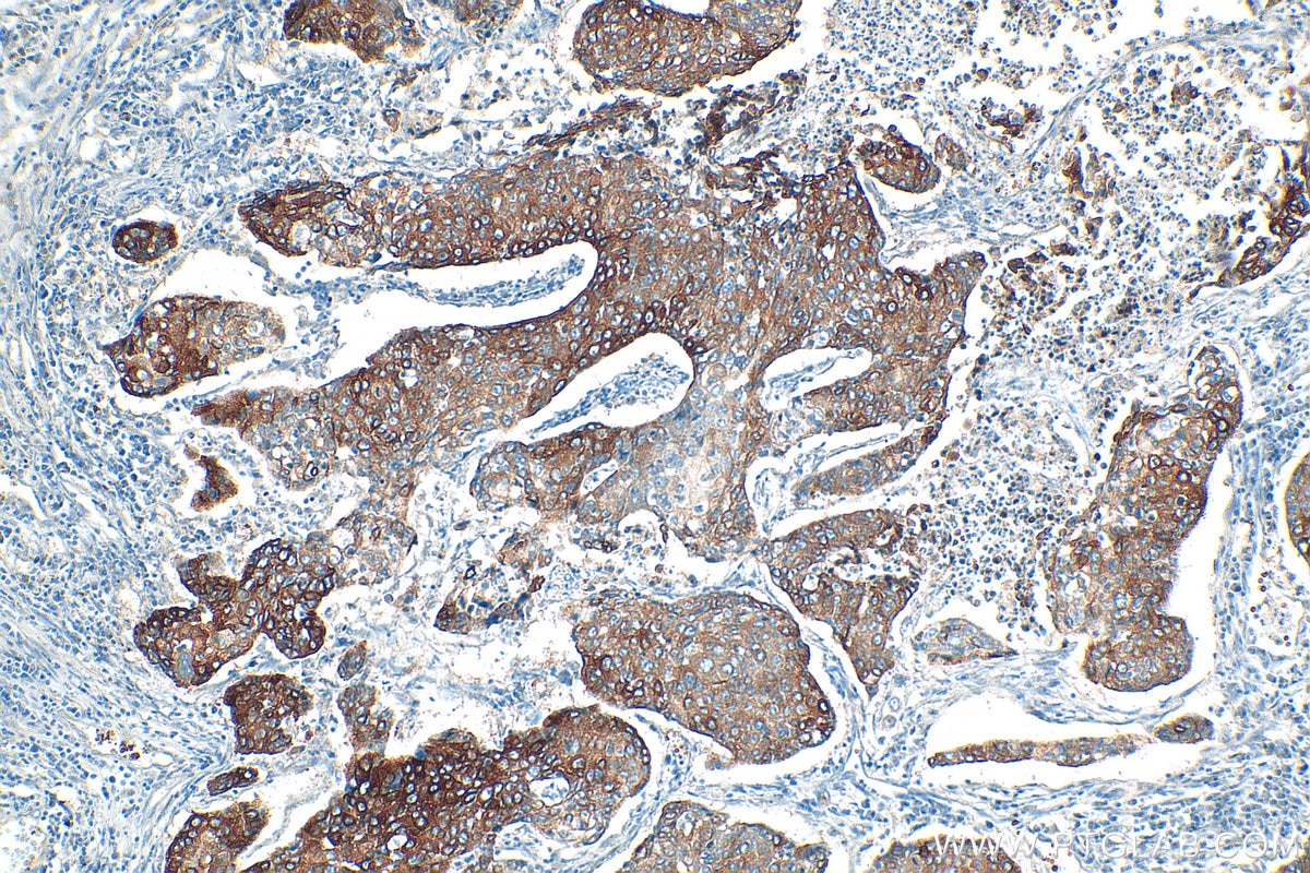 Immunohistochemistry (IHC) staining of human lung cancer tissue using EPPK1 Polyclonal antibody (31475-1-AP)