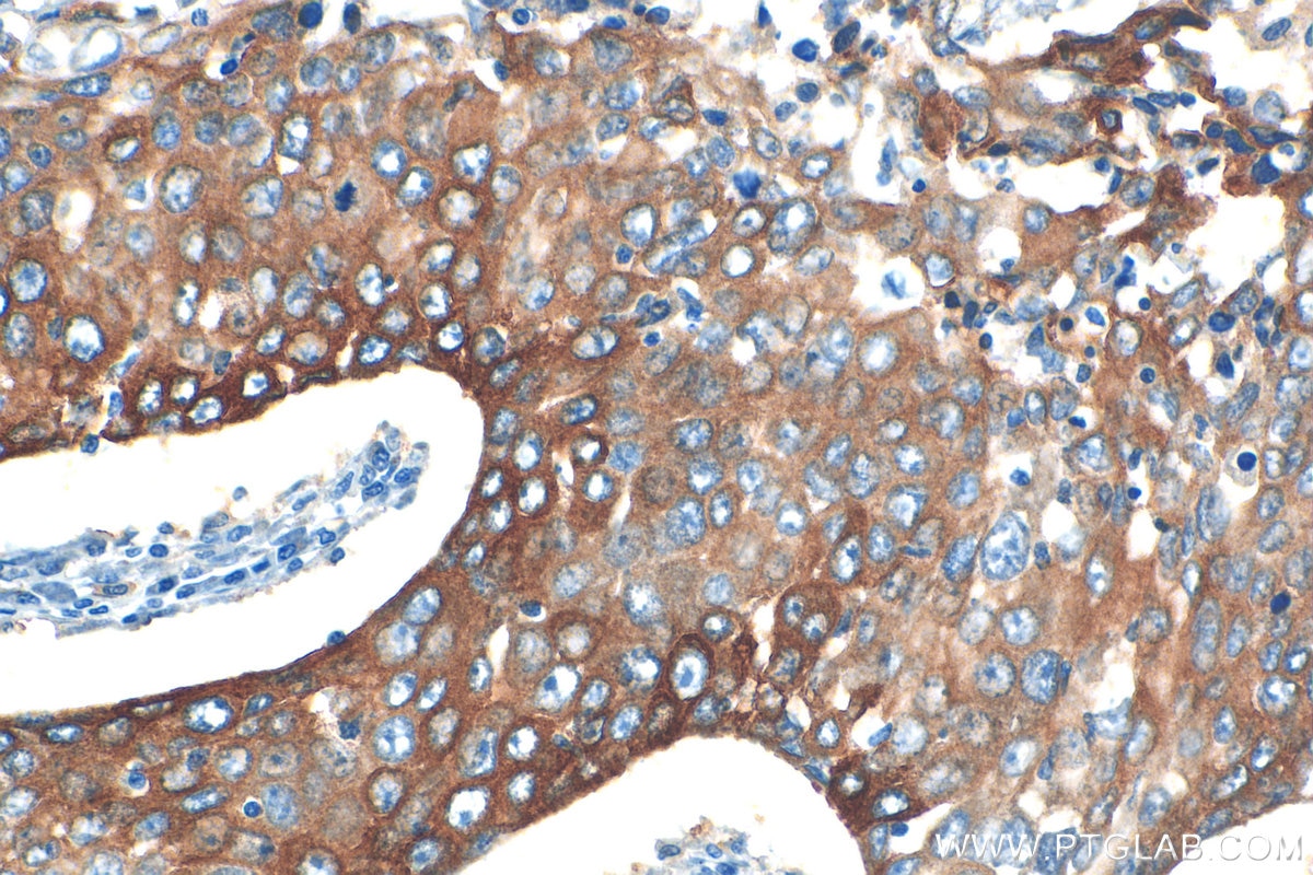 Immunohistochemistry (IHC) staining of human lung cancer tissue using EPPK1 Polyclonal antibody (31475-1-AP)