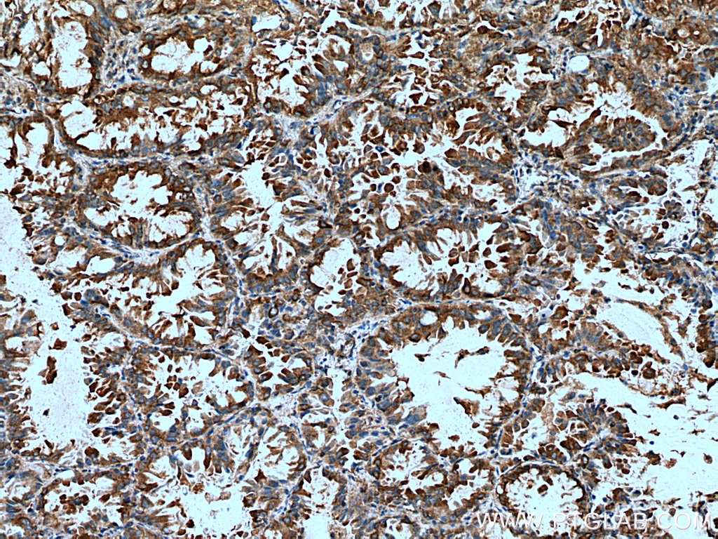 Immunohistochemistry (IHC) staining of human lung cancer tissue using EPRS Monoclonal antibody (67712-1-Ig)