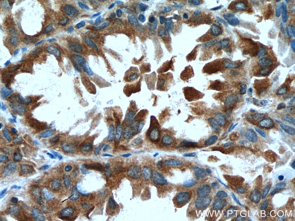 Immunohistochemistry (IHC) staining of human lung cancer tissue using EPRS Monoclonal antibody (67712-1-Ig)