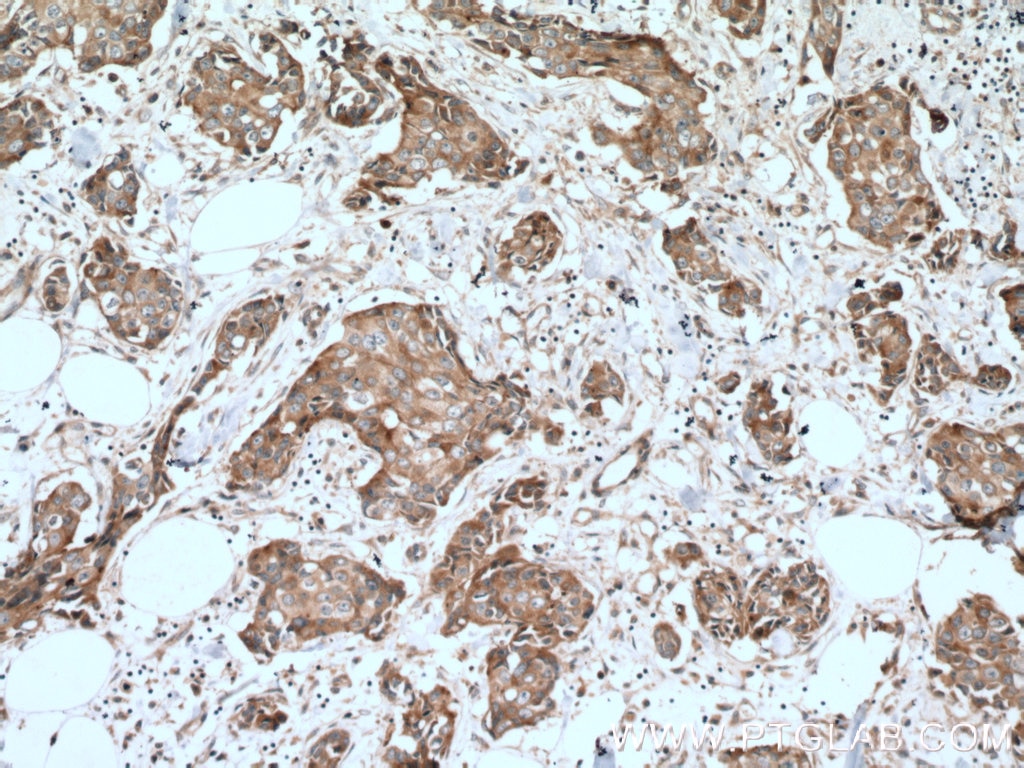 Immunohistochemistry (IHC) staining of human breast cancer tissue using EPS8 Polyclonal antibody (12455-1-AP)