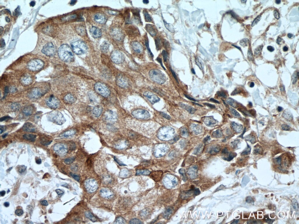 Immunohistochemistry (IHC) staining of human breast cancer tissue using EPS8 Polyclonal antibody (12455-1-AP)