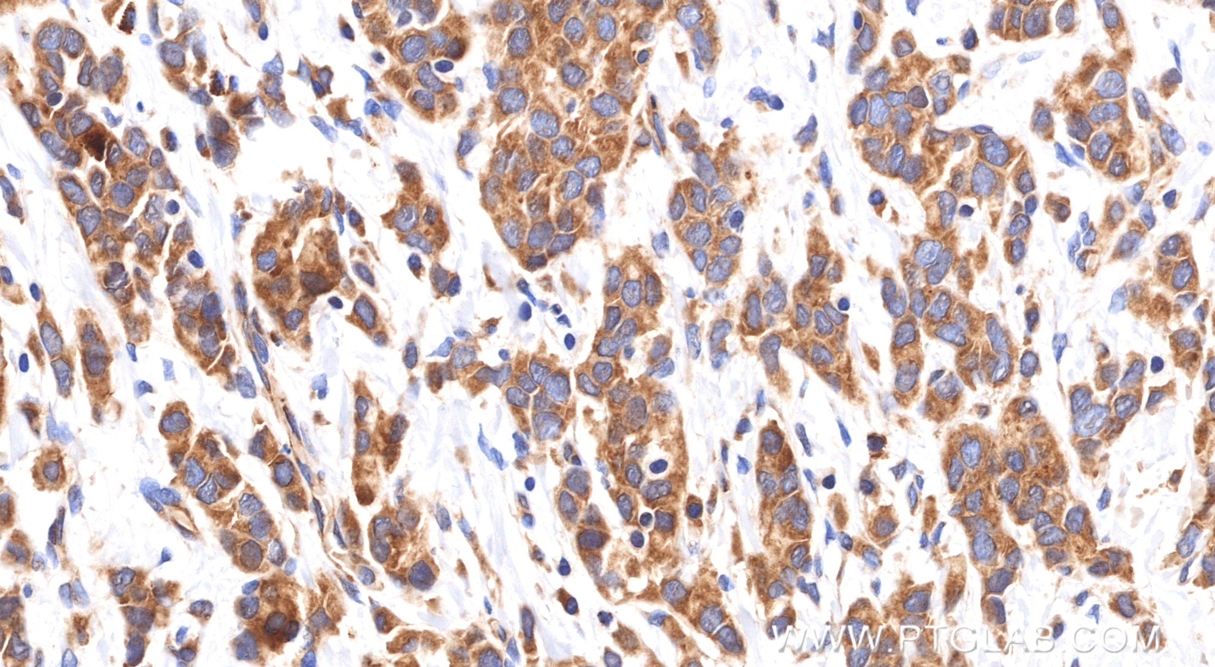 Immunohistochemistry (IHC) staining of human breast cancer tissue using EPS8 Recombinant monoclonal antibody (85184-5-RR)