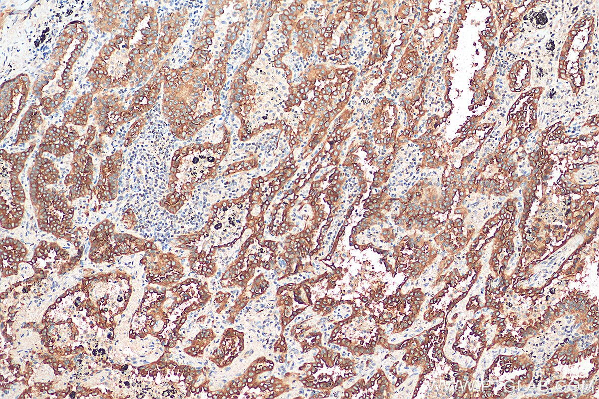 Immunohistochemistry (IHC) staining of human lung cancer tissue using EPS8L2 Polyclonal antibody (20461-1-AP)
