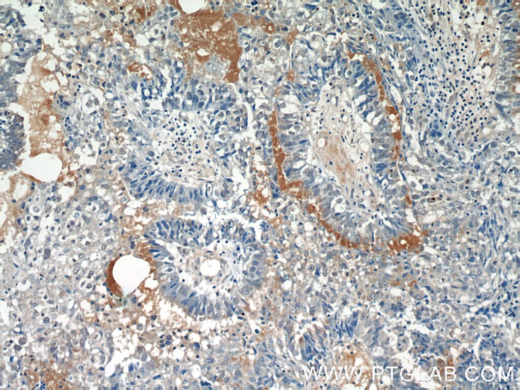 Immunohistochemistry (IHC) staining of human breast cancer tissue using EPSTI1 Polyclonal antibody (11627-1-AP)