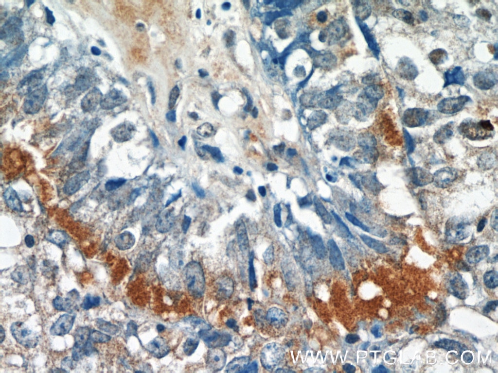 Immunohistochemistry (IHC) staining of human breast cancer tissue using EPSTI1 Polyclonal antibody (11627-1-AP)