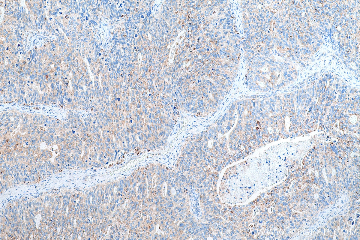 Immunohistochemistry (IHC) staining of human ovary tumor tissue using EPX Polyclonal antibody (29755-1-AP)