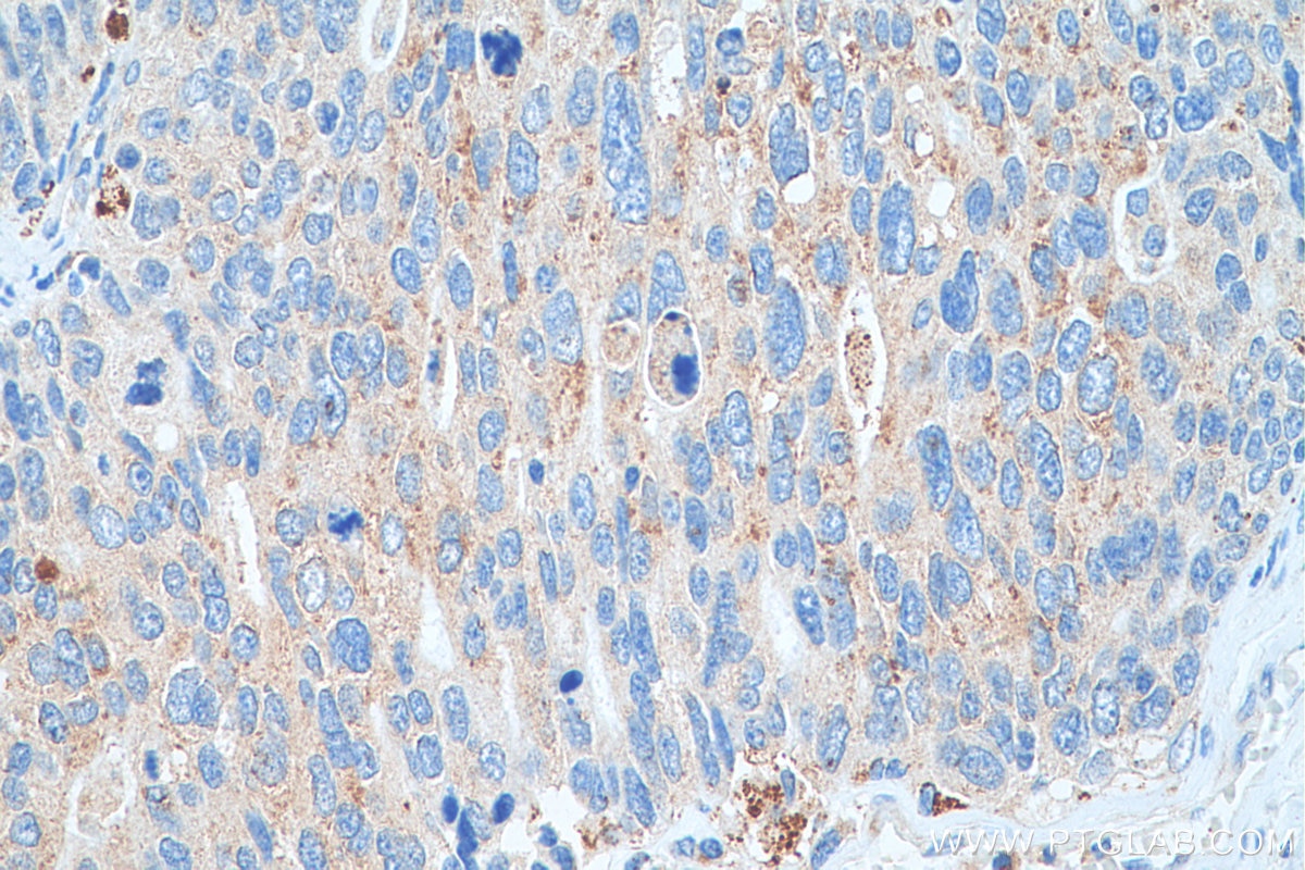 Immunohistochemistry (IHC) staining of human ovary tumor tissue using EPX Polyclonal antibody (29755-1-AP)