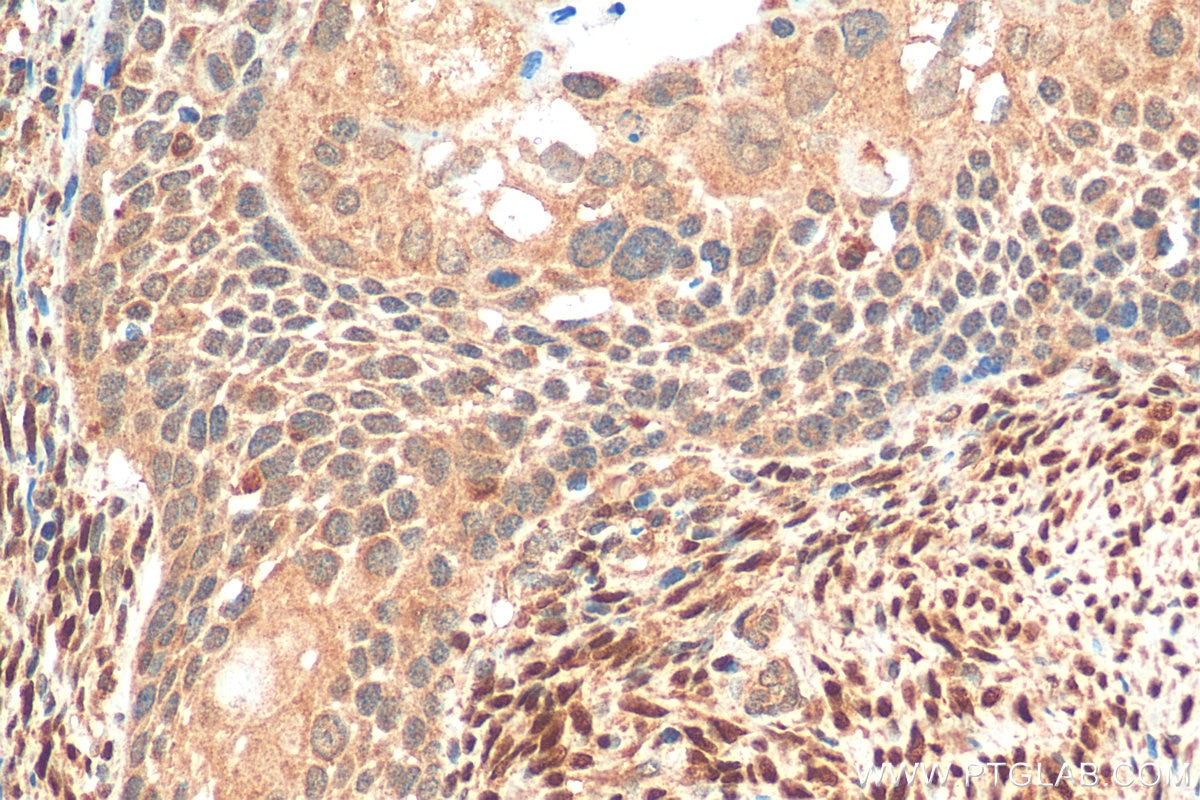 Immunohistochemistry (IHC) staining of human cervical cancer tissue using ER Polyclonal antibody (20698-1-AP)
