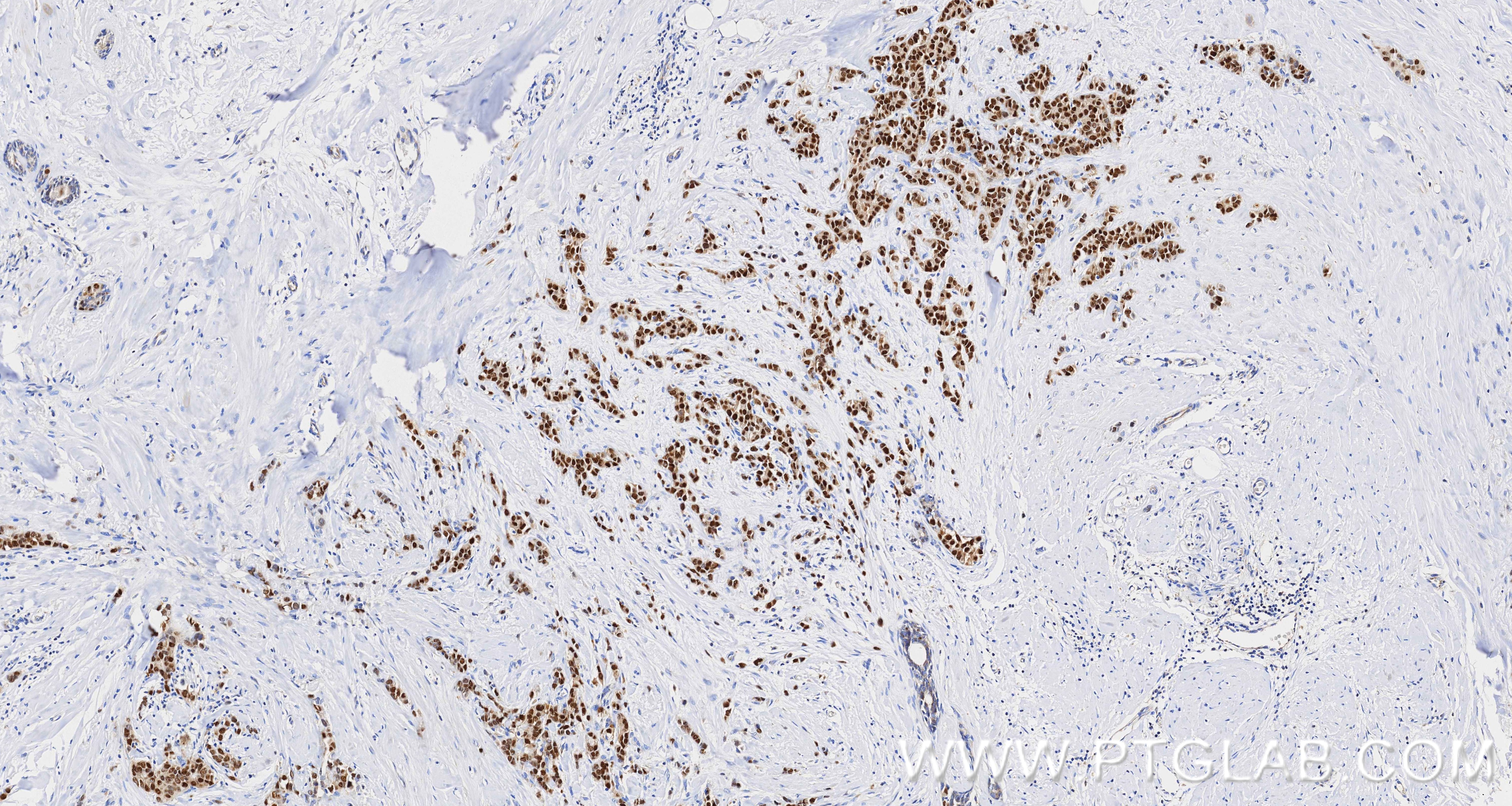 IHC staining of human breast cancer using 84564-11-RR Immunohistochemistry (IHC) staining of human breast cancer tissue using ER Recombinant monoclonal antibody (84564-11-RR)
