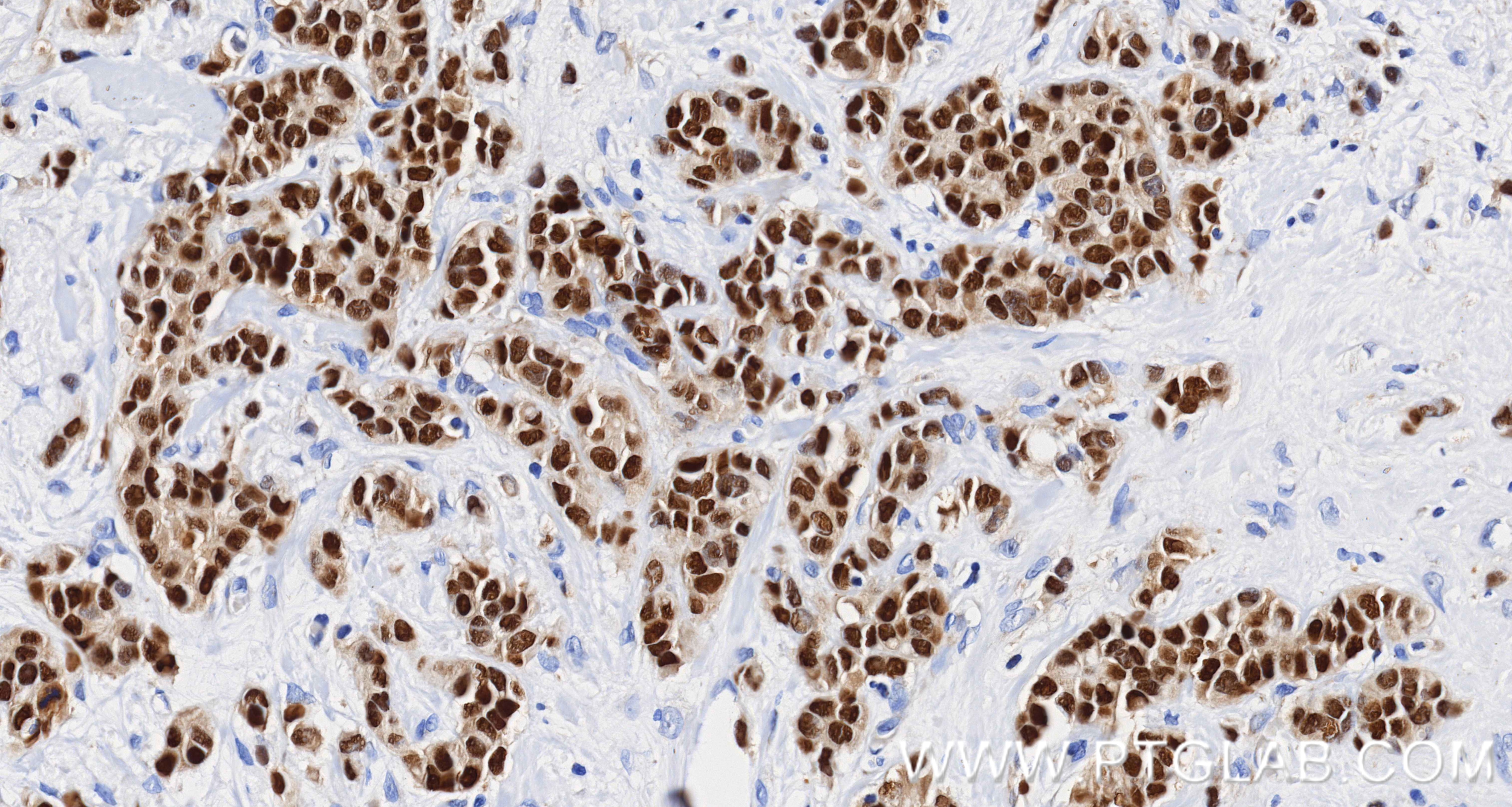 IHC staining of human breast cancer using 84564-11-RR Immunohistochemistry (IHC) staining of human breast cancer tissue using ER Recombinant monoclonal antibody (84564-11-RR)