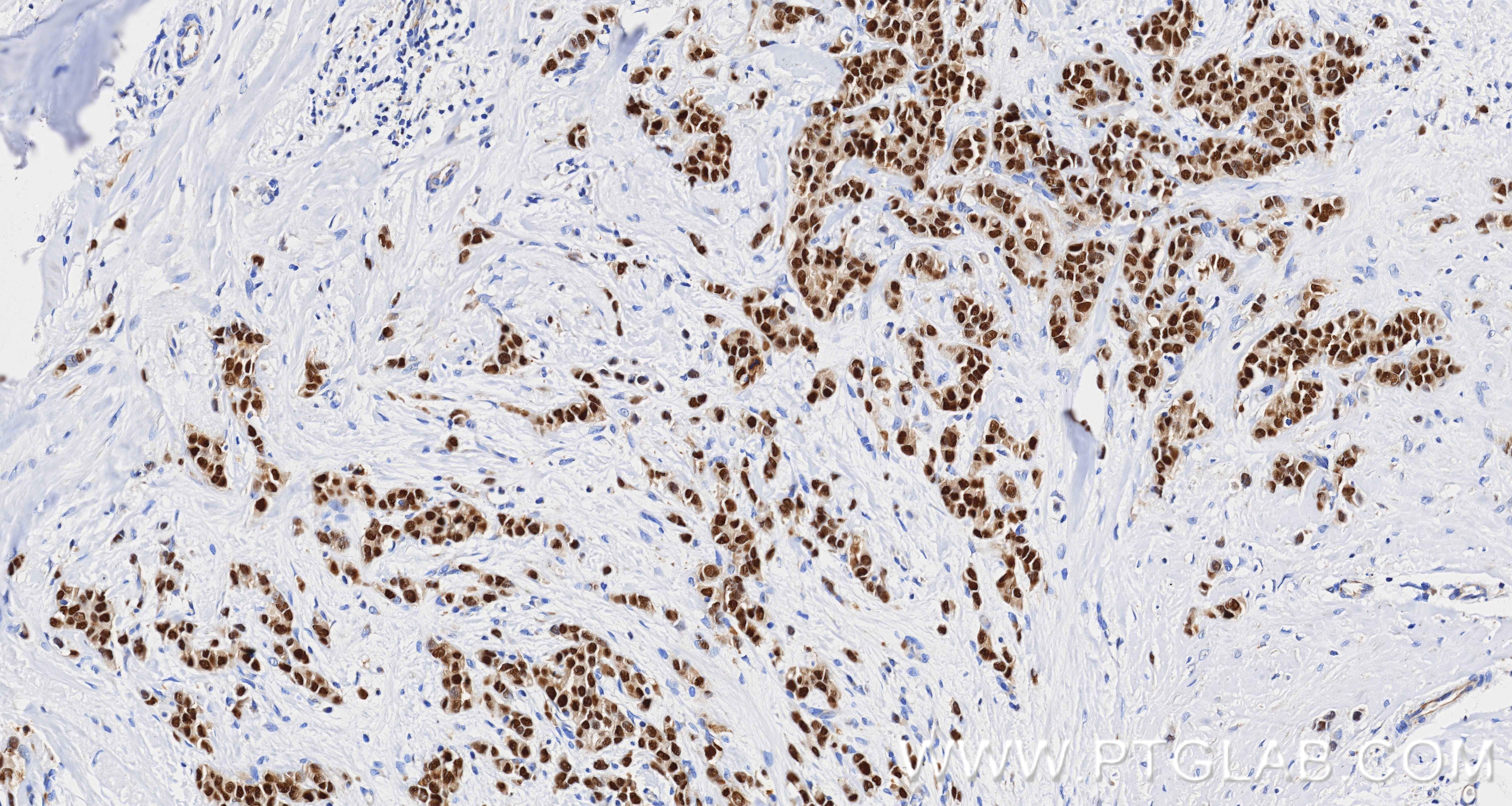 IHC staining of human breast cancer using 84564-11-RR Immunohistochemistry (IHC) staining of human breast cancer tissue using ER Recombinant monoclonal antibody (84564-11-RR)
