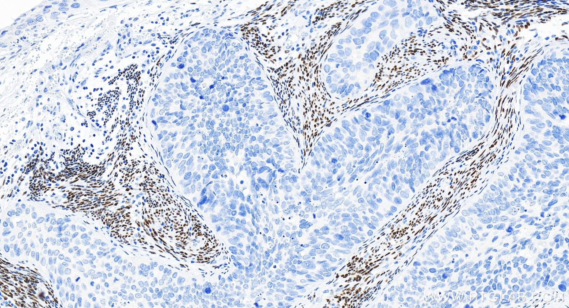 Immunohistochemistry (IHC) staining of human cervical cancer tissue using ER Recombinant antibody (84564-4-RR)