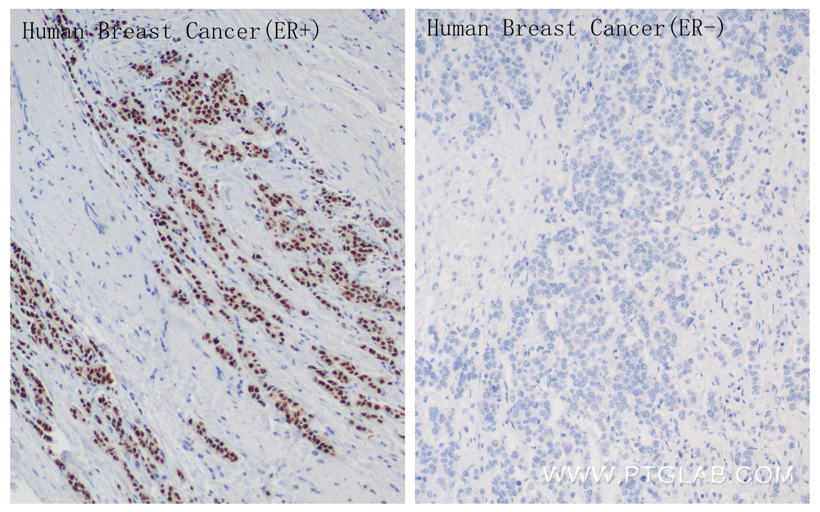 Immunohistochemistry (IHC) staining of human breast cancer tissue using ER Recombinant antibody (84564-4-RR)