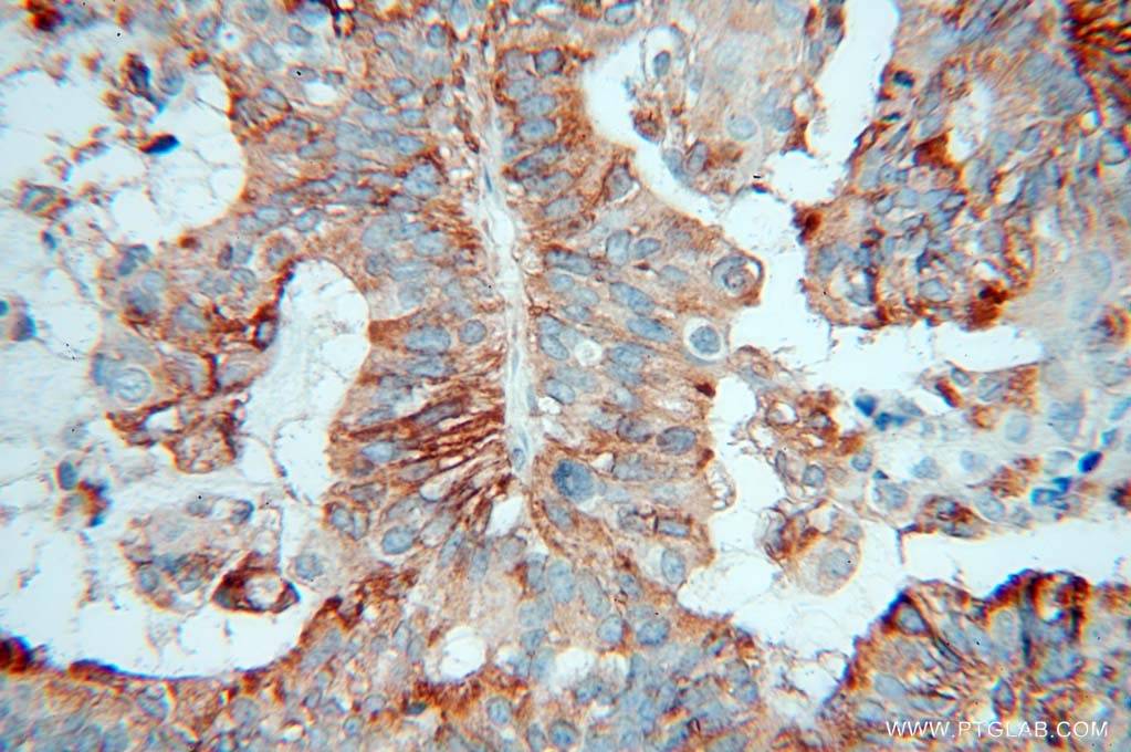 IHC staining of human ovary tumor using 13821-1-AP