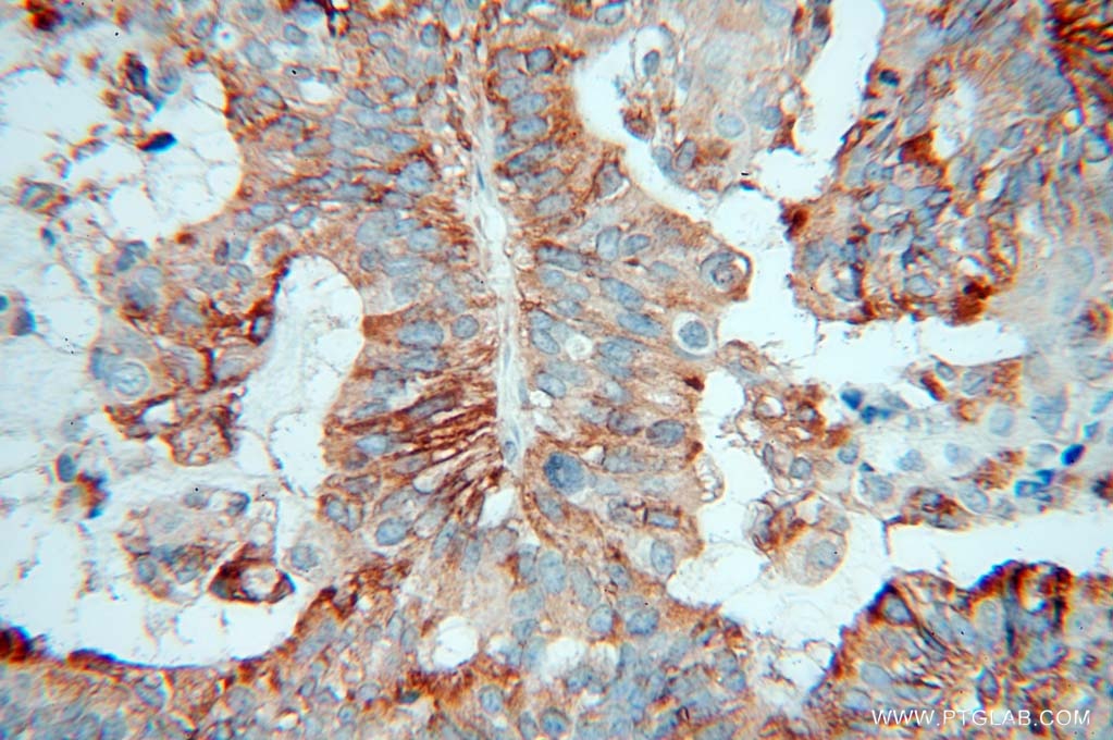 Immunohistochemistry (IHC) staining of human ovary tumor tissue using ARTS1 Polyclonal antibody (13821-1-AP)