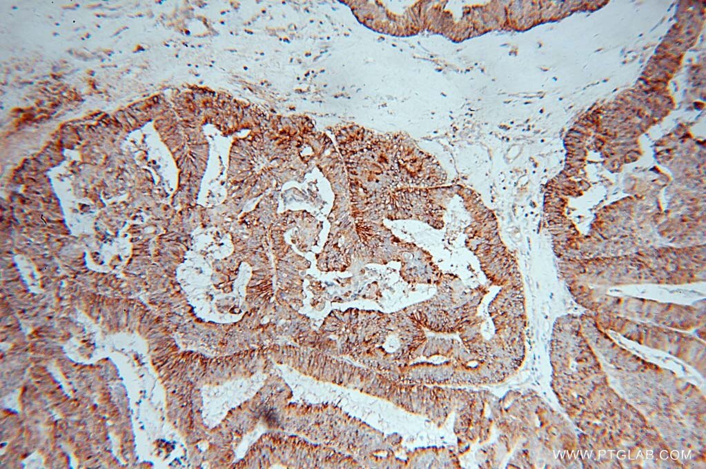 Immunohistochemistry (IHC) staining of human ovary tumor tissue using ARTS1 Polyclonal antibody (13821-1-AP)