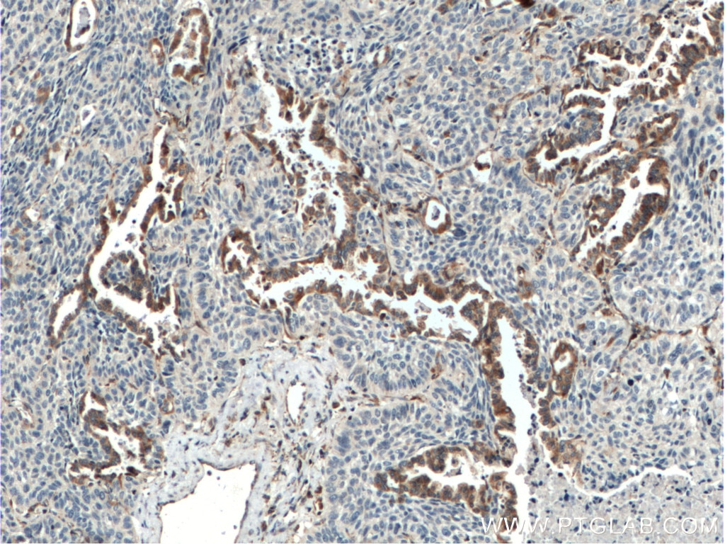 Immunohistochemistry (IHC) staining of human lung cancer tissue using ERAP2 Polyclonal antibody (14637-1-AP)