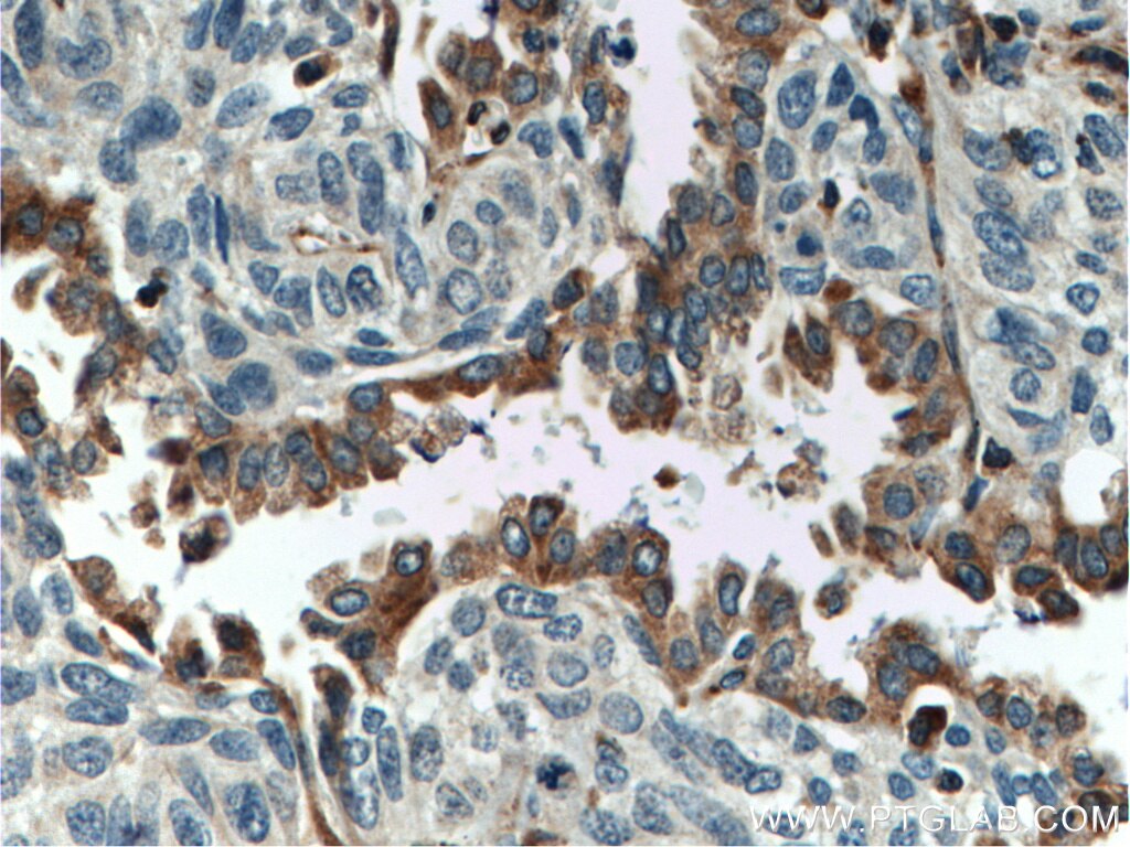 Immunohistochemistry (IHC) staining of human lung cancer tissue using ERAP2 Polyclonal antibody (14637-1-AP)