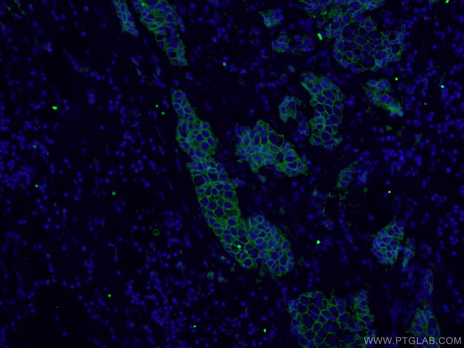 Immunofluorescence (IF) / fluorescent staining of human breast cancer tissue using HER2/ErbB2 Polyclonal antibody (18299-1-AP)