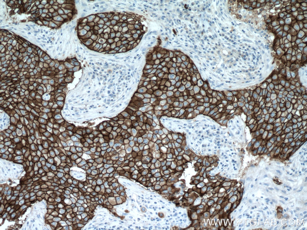 Immunohistochemistry (IHC) staining of human breast cancer tissue using HER2/ErbB2 Polyclonal antibody (18299-1-AP)