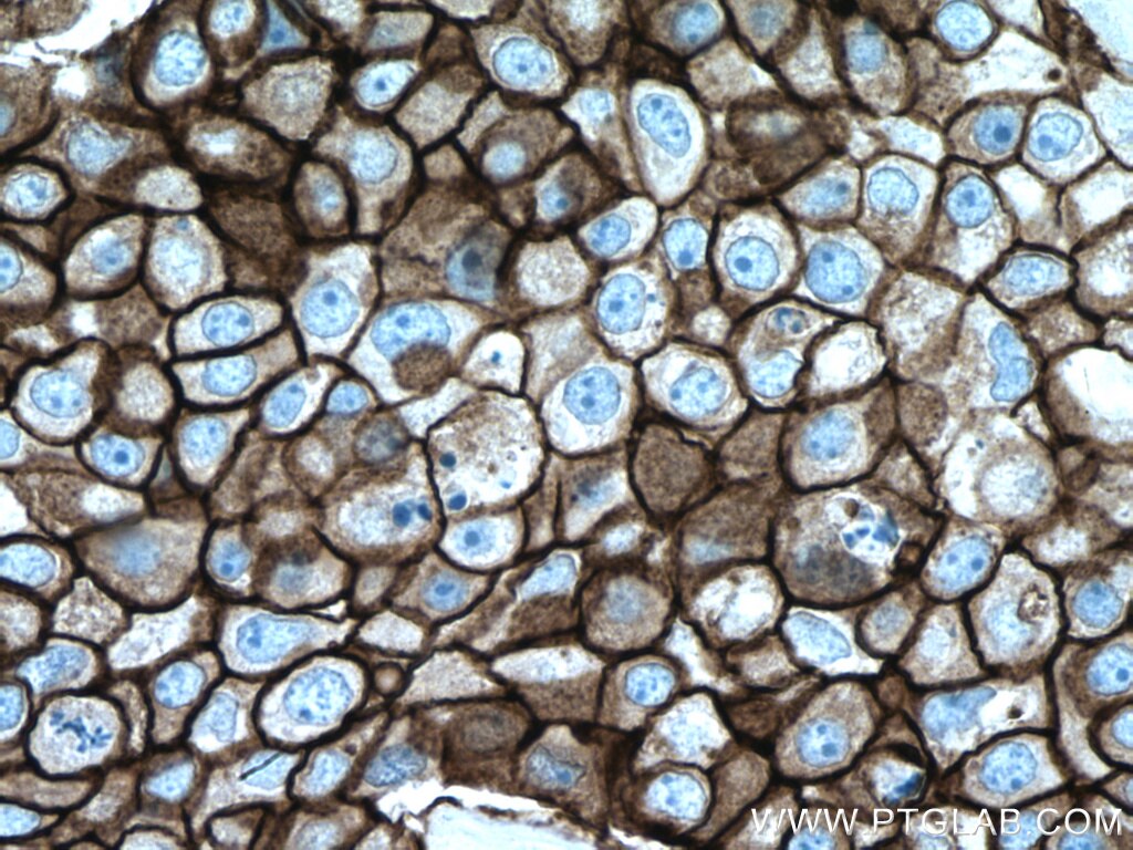 Immunohistochemistry (IHC) staining of human breast cancer tissue using HER2/ErbB2 Polyclonal antibody (18299-1-AP)