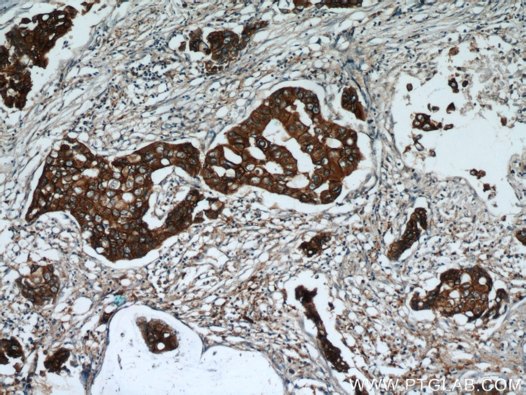 Immunohistochemistry (IHC) staining of human breast cancer tissue using HER2/ErbB2 Polyclonal antibody (18299-1-AP)