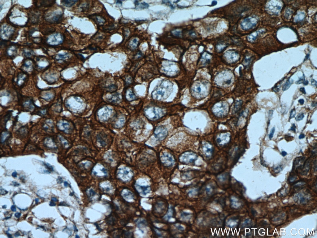 Immunohistochemistry (IHC) staining of human breast cancer tissue using HER2/ErbB2 Polyclonal antibody (18299-1-AP)