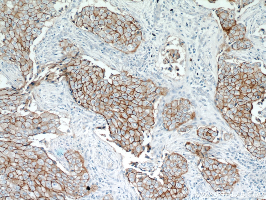 Immunohistochemistry (IHC) staining of human breast cancer tissue using HER2/ErbB2 Polyclonal antibody (18299-1-AP)