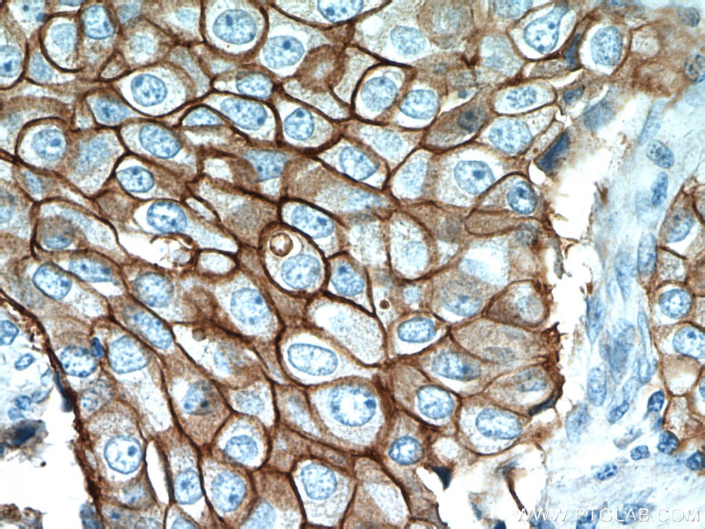 IHC staining of human breast cancer using 18299-1-AP