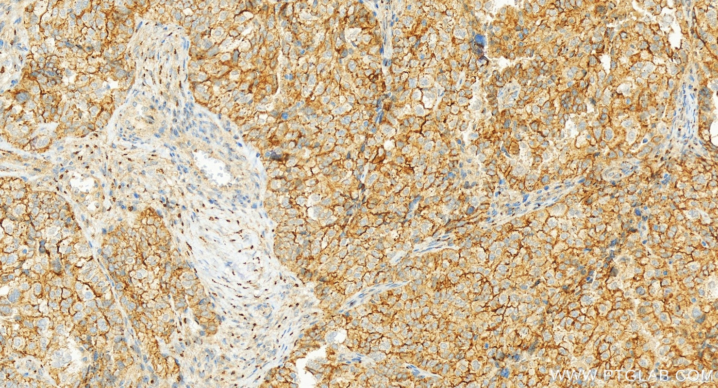 Immunohistochemistry (IHC) staining of human ovary cancer tissue using HER2/ErbB2 Polyclonal antibody (18299-1-AP)