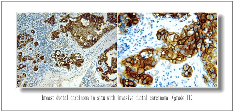 Immunohistochemistry (IHC) staining of Breast Cancer slides using HER2/ErbB2 Polyclonal antibody (51105-1-AP)