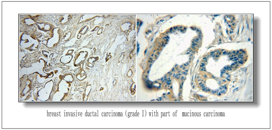 IHC staining of Breast Cancer slides using 51105-1-AP