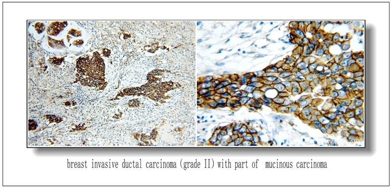 Immunohistochemistry (IHC) staining of Breast Cancer slides using HER2/ErbB2 Polyclonal antibody (51105-1-AP)